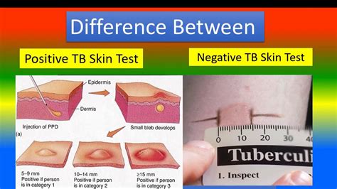 cvs tuberculosis test|TB Testing .